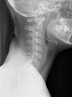 Neck X-Ray Neck X-Ray